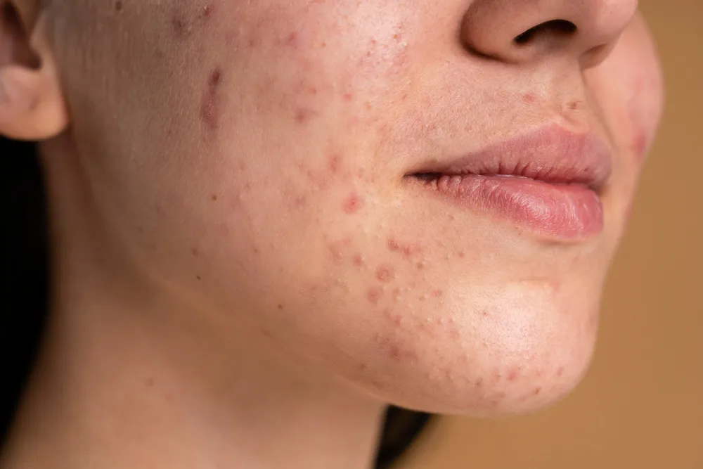Acne begrijpen begint bij de juiste diagnose