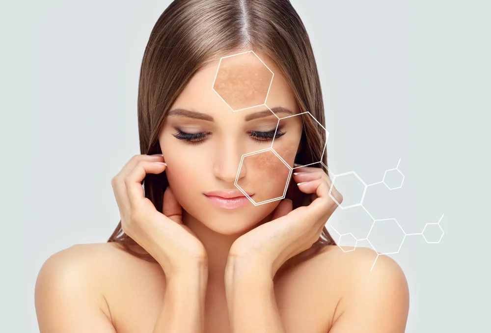 Melasma hardnekkige pigmentatie met een hormonale component