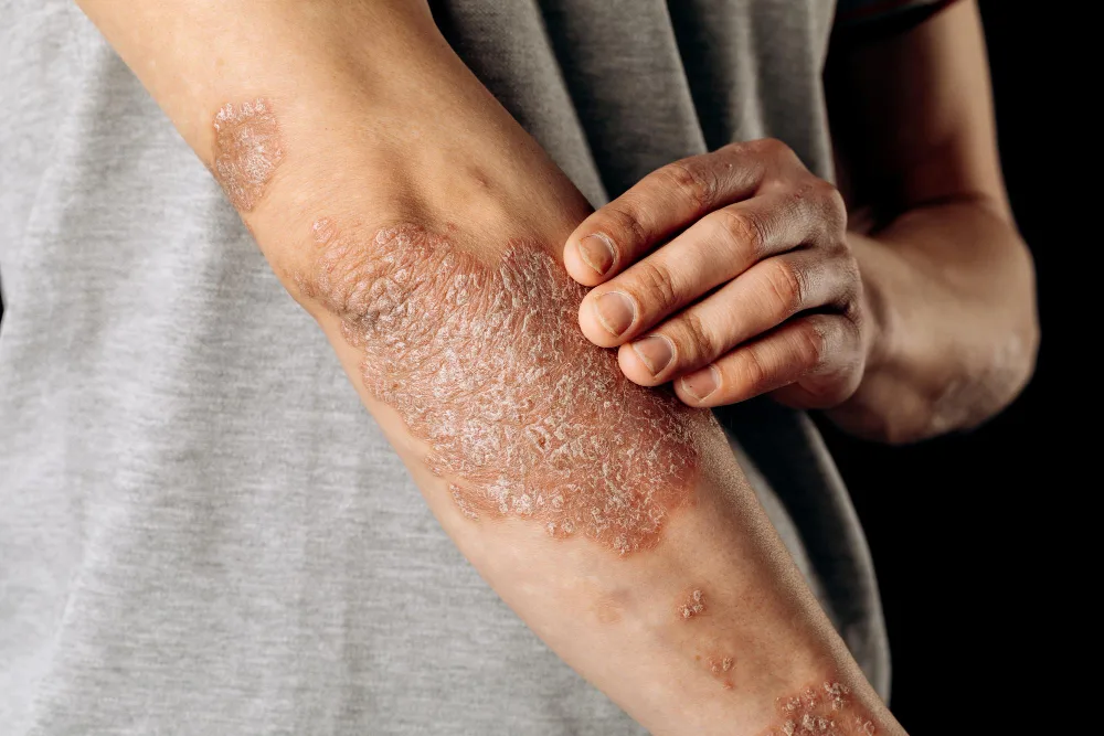 Psoriasis een auto immuunaandoening van de huid