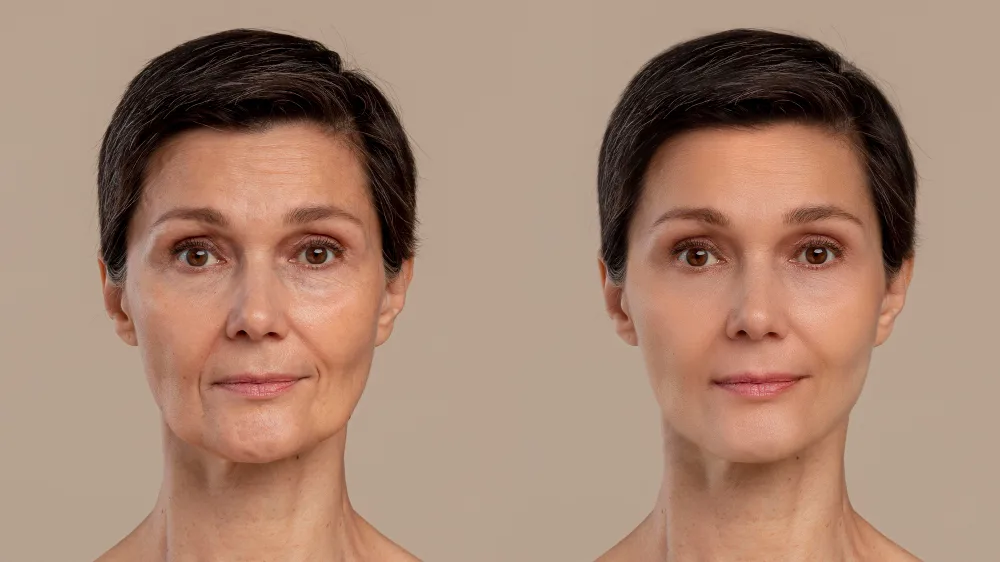 Resultaat: voor en na