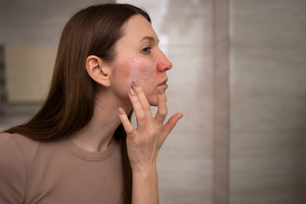 Rosacea een chronische huidaandoening die je kunt managen