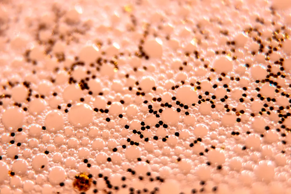 Wat vette huid veroorzaakt